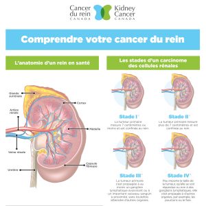 Comprendre votre cancer du rein